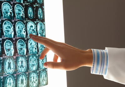 doctor reviewing scans from a brain injury