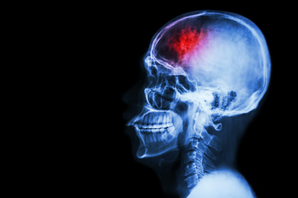 common brain injury, concussion xray