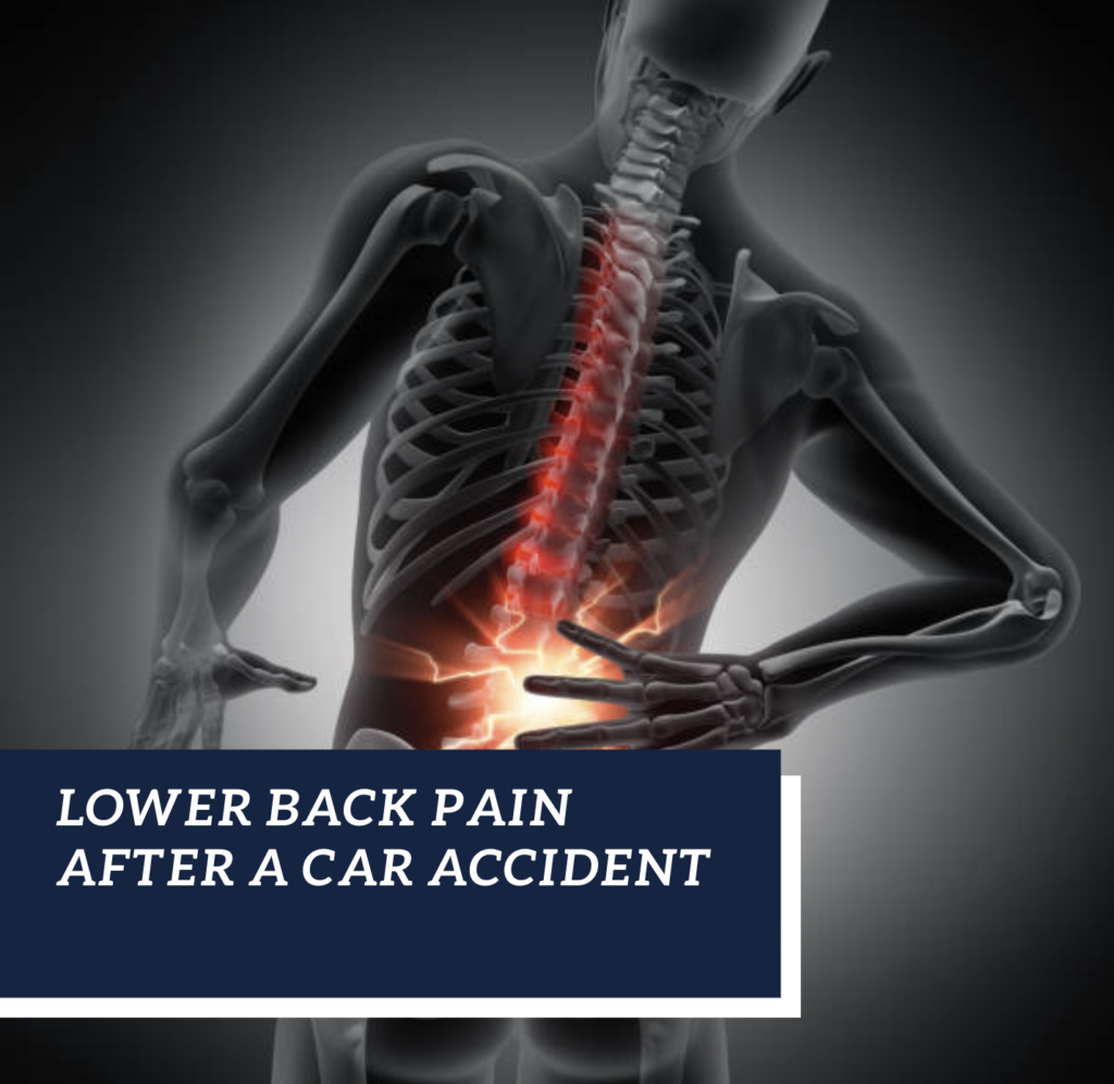 Lower Back Pain After a Car Accident Geiger Legal Group, LLCGeiger