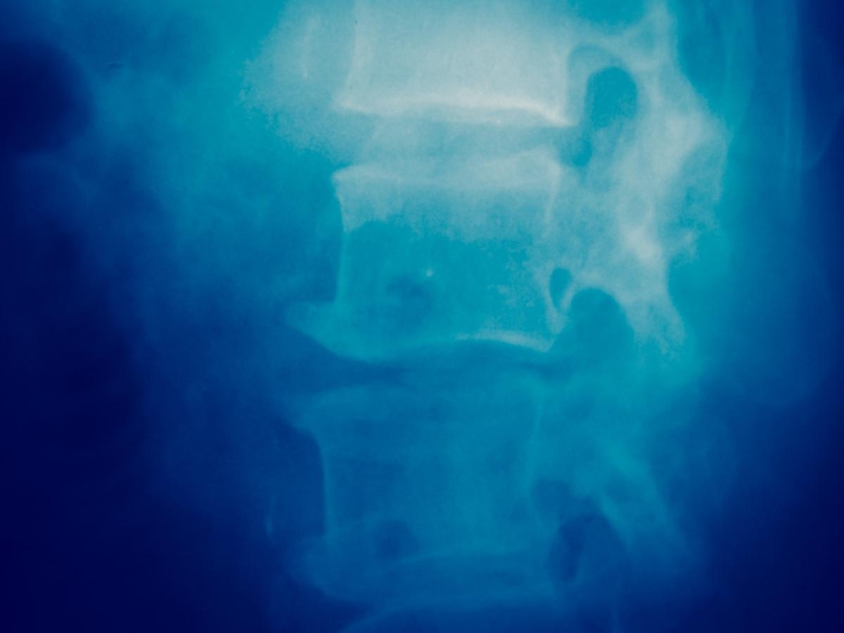 Injured spine x-ray scan
