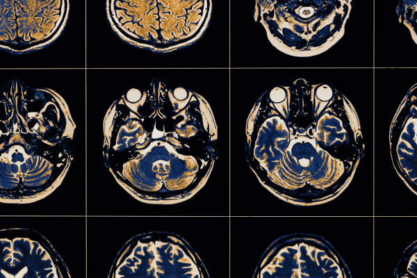 Types of Brain Injuries